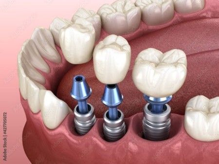 Implante Dentário Múltiplo - Mordent Clínica Odontológica em Blumenau