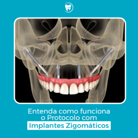 Implante Tipo Zigomático - Mordent Clínica Odontológica em Blumenau